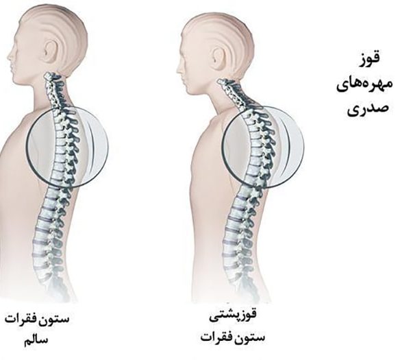 انواع کیفوز