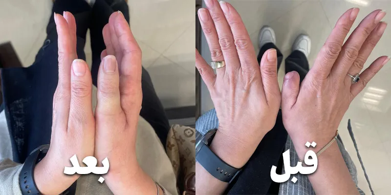 پروتز انگشتان دست - ارتوپدی فنی در اصفهان