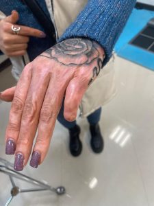 قطع انگشتان دست