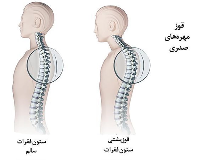 انواع کیفوز