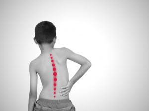 اسکولیوز ایدیوپاتیک در کودکان و نوجوانان