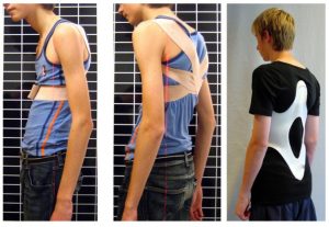 بریس برای درمان کیفوز