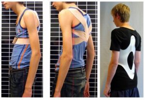 درمان قوز کمر با بریس