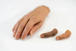 پروتز انگشتان دست