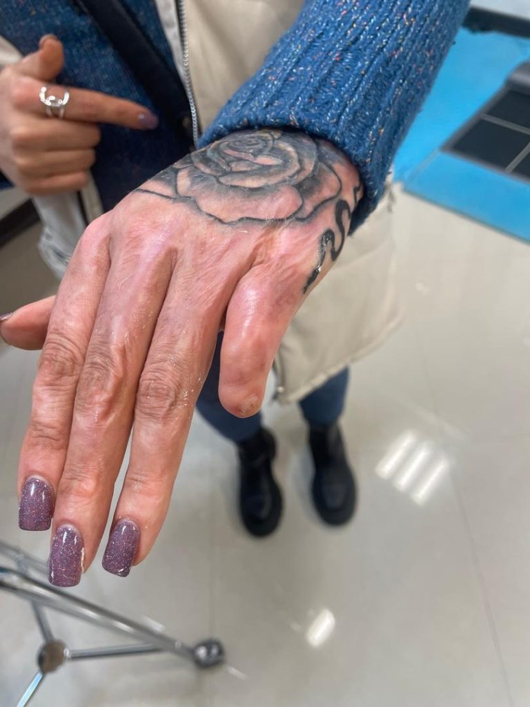 قطع انگشتان دست