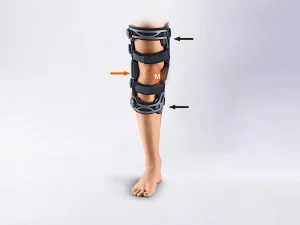 اصلاح زانو ضربدری با بریس